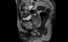 Faster scan time with Deep Resolve for TSE outruns motion and substantially shortens the prostate exam