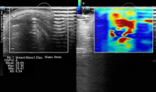 Ultrasound offers a supplemental scan and peace of mind in its ability to find the pathology and almost instantaneously distinguishes a benign cyst from a possible or definite cancer