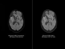 Siemens Healthineers simultaneous Multi-Slice (SMS) acquires multiple diffusion tensor imaging (DTI) slices simultaneously.