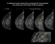 There is a rapid adoption of 3D Breast tomosynthesis imaging systems.