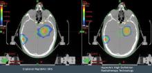 High Definition Radiotherapy (HDRT) 