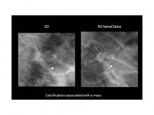 GE, SenoClaire, mammography, 3-D breast imaging, tomosynthesis, dense breast tissue