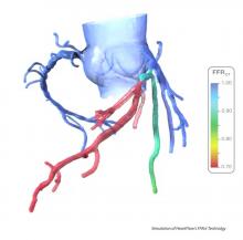 FFR-CT, heartflow