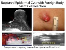 Figure 2.  Vessel mapping preoperative.