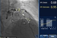 SyncVision iFR Co-registration from Philips Healthcare maps iFR pressure readings onto angiogram.