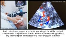 Adult patient case suspect of potential narrowing of the middle cerebral artery, however, a repositioned scan (right) with normal Doppler flow approximating 60 cm/s implies no disease in the artery except for tortuosity.